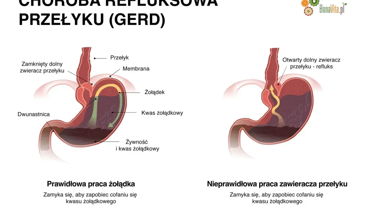 Ilustracja pokazuje refluks żołądkowo-przełykowy, który może powodować ból gardła. Po lewej prawidłowe działanie żołądka, po prawej refluks.
