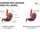 Ilustracja pokazuje refluks żołądkowo-przełykowy, który może powodować ból gardła. Po lewej prawidłowe działanie żołądka, po prawej refluks.