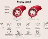 Objawy anemii: bladość, zmęczenie, bóle głowy. Leczenie anemii jest kluczowe dla poprawy samopoczucia.
