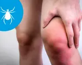 Ból stawów przy boreliozie. Czerwone, opuchnięte kolano, symbol kleszcza. Jak uśmierzyć ból przy boreliozie?