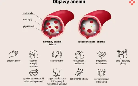 Objawy anemii: bladość, zmęczenie, bóle głowy. Leczenie anemii jest kluczowe dla poprawy samopoczucia.