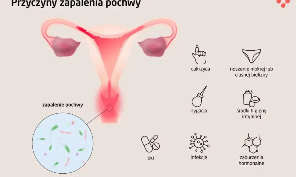 Ilustracja przedstawia przyczyny zapalenia pochwy, w tym infekcje intymne, cukrzycę i zaburzenia hormonalne.