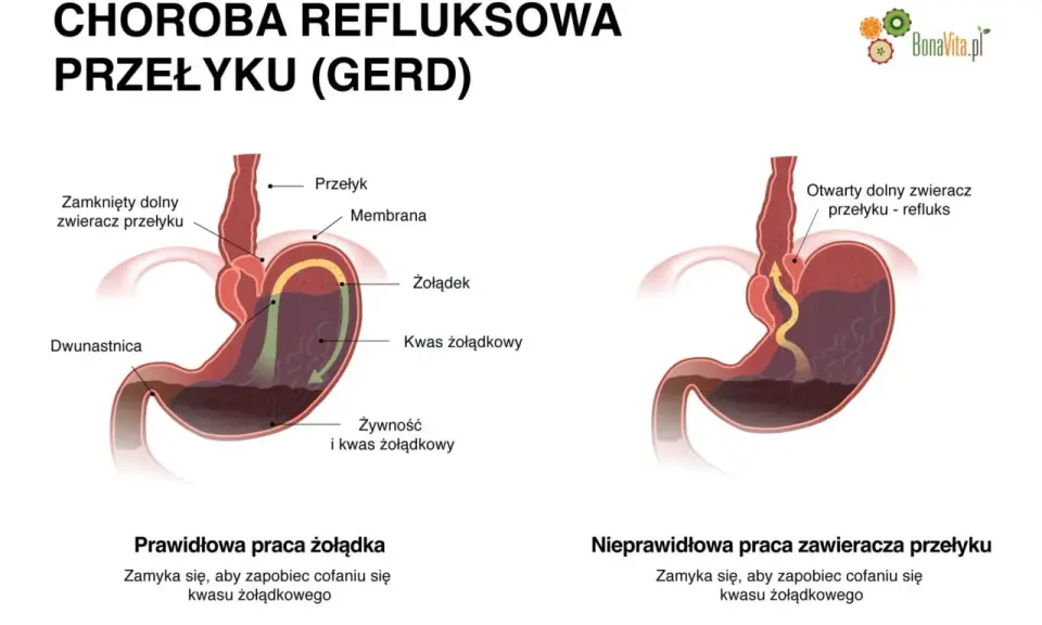 Ilustracja pokazuje refluks żołądkowo-przełykowy, który może powodować ból gardła. Po lewej prawidłowe działanie żołądka, po prawej refluks.