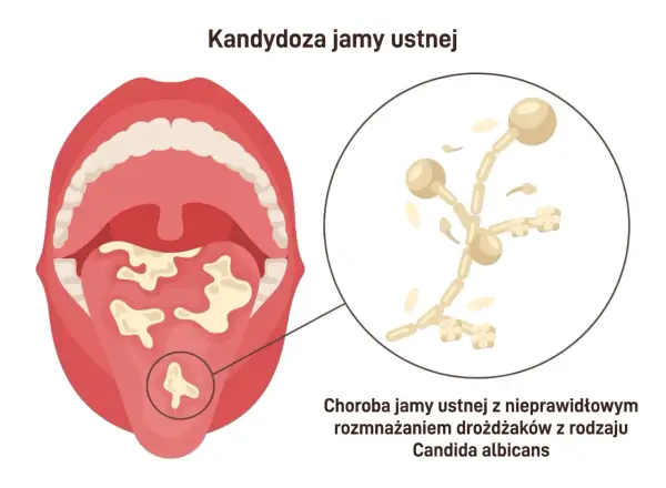 Kandydoza jamy ustnej: białe naloty na języku i podniebieniu, powiększone drożdżaki Candida. Czy kandydoza jest zaraźliwa?